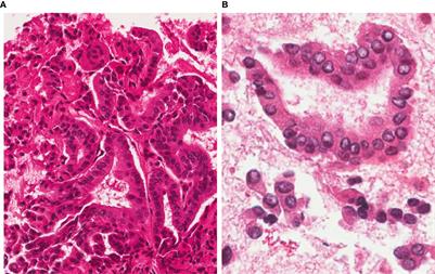 Radiofrequency Thermal Ablation for a Small Papillary Thyroid Carcinoma in a Patient Unfit for Surgery: A Case Report